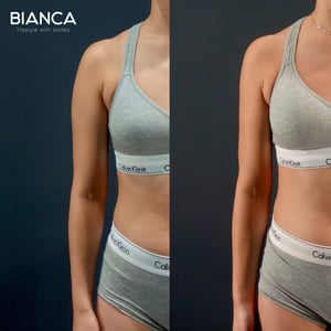 VASER Liposuction｜BIANCA CLINIC in Tokyo, Japan